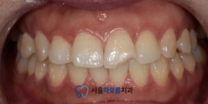 세마역 앞니치료 365서울차오름치과