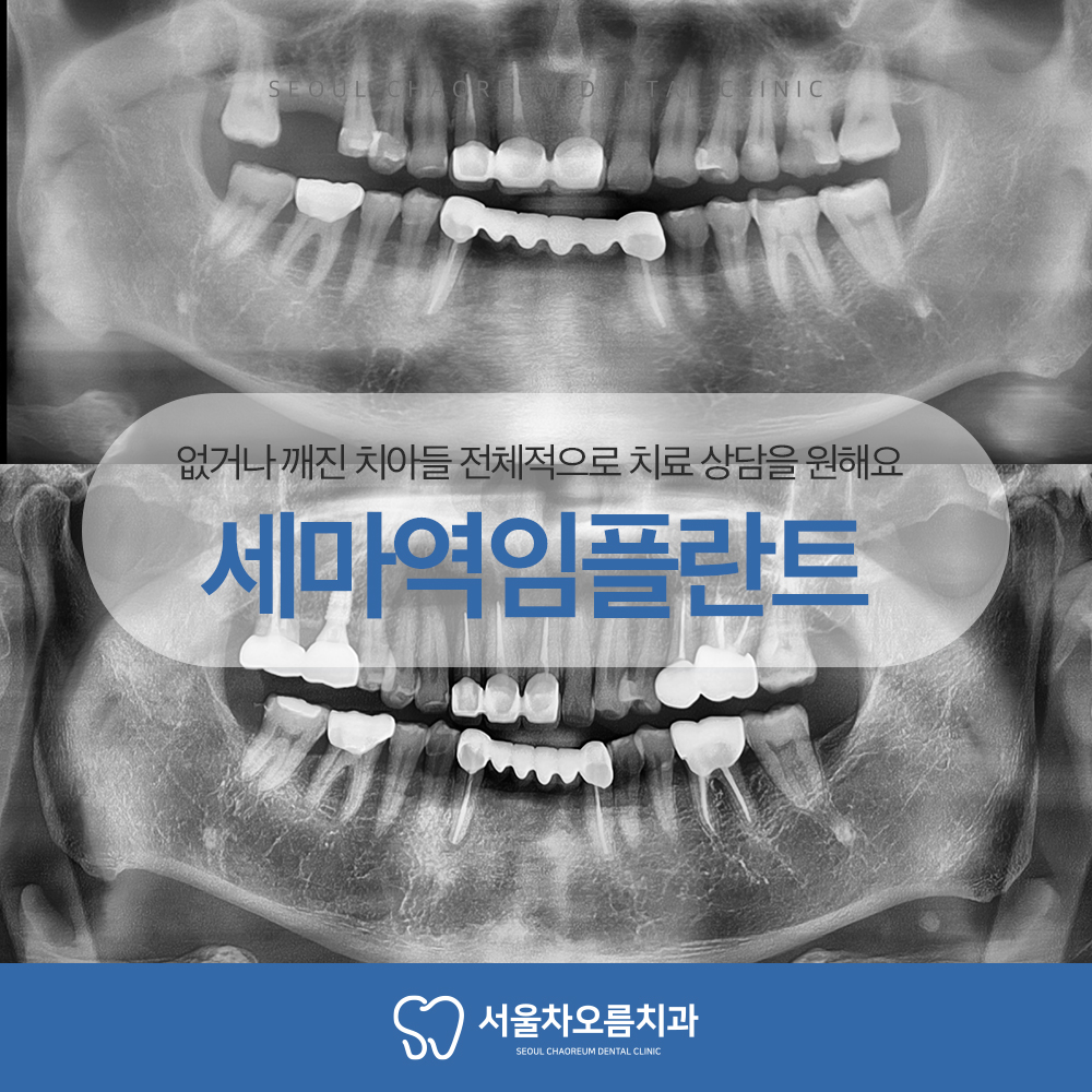 세마역임플란트
