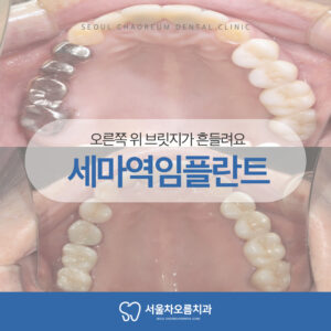 세마역임플란트