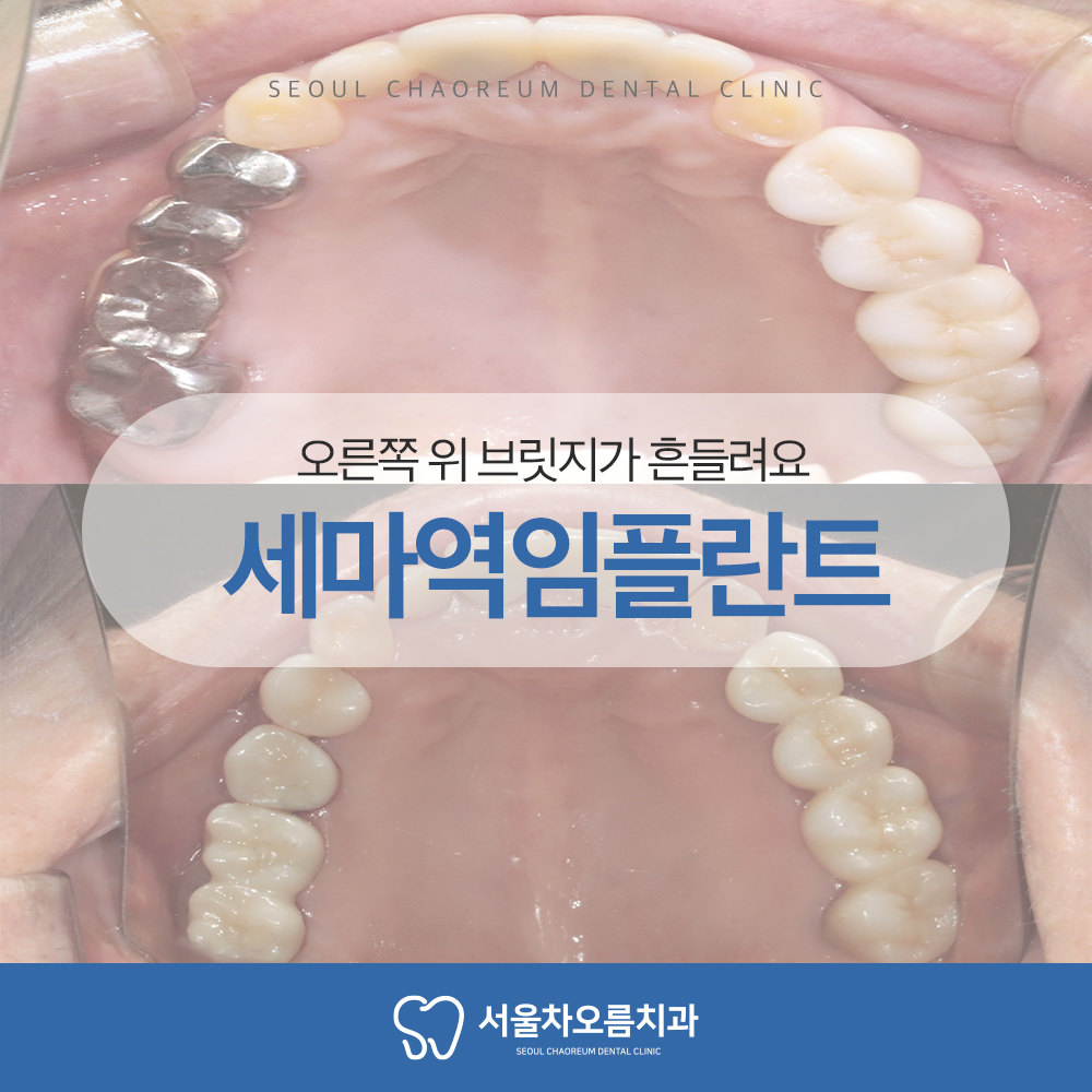 세마역임플란트 