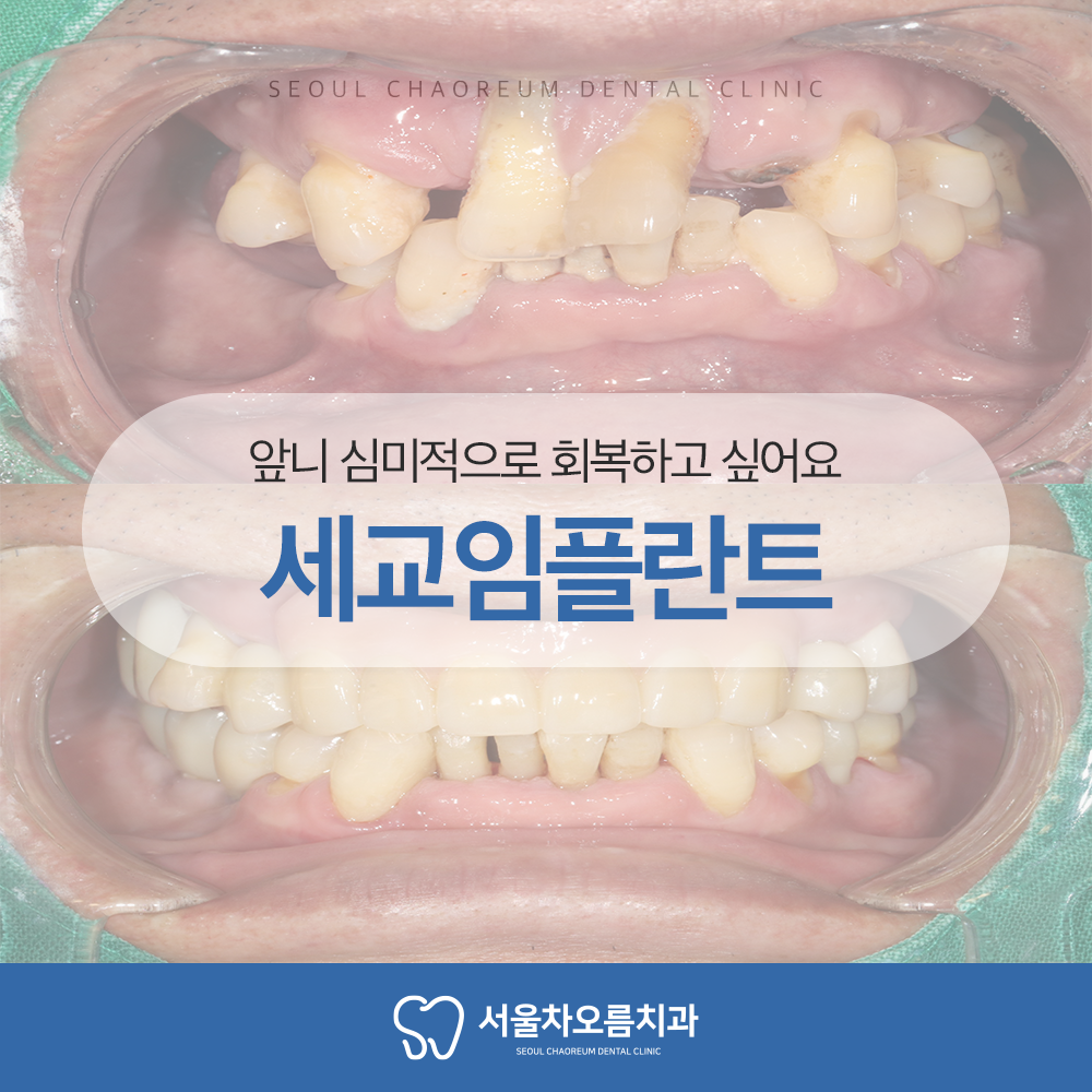 세교임플란트
