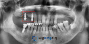 오산대역임플란트