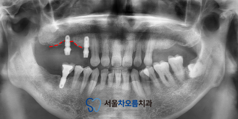 오산대역임플란트