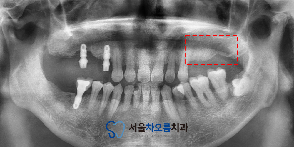 오산대역임플란트