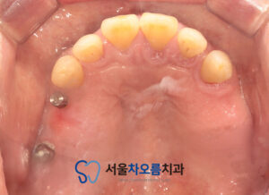 오산대역임플란트