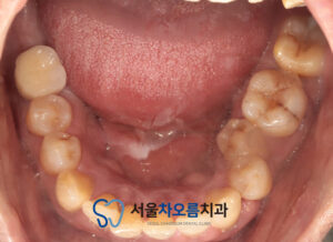 오산대역임플란트