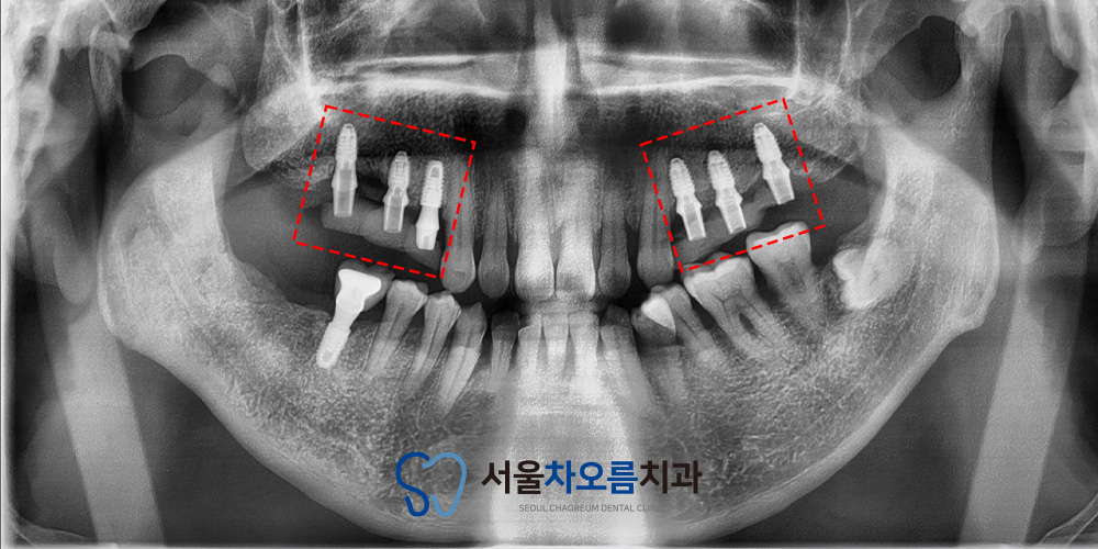 오산대역임플란트