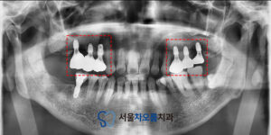오산대역임플란트