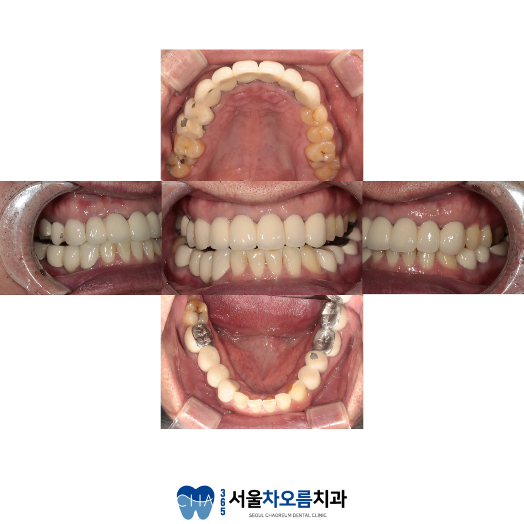 오대산역임플란트