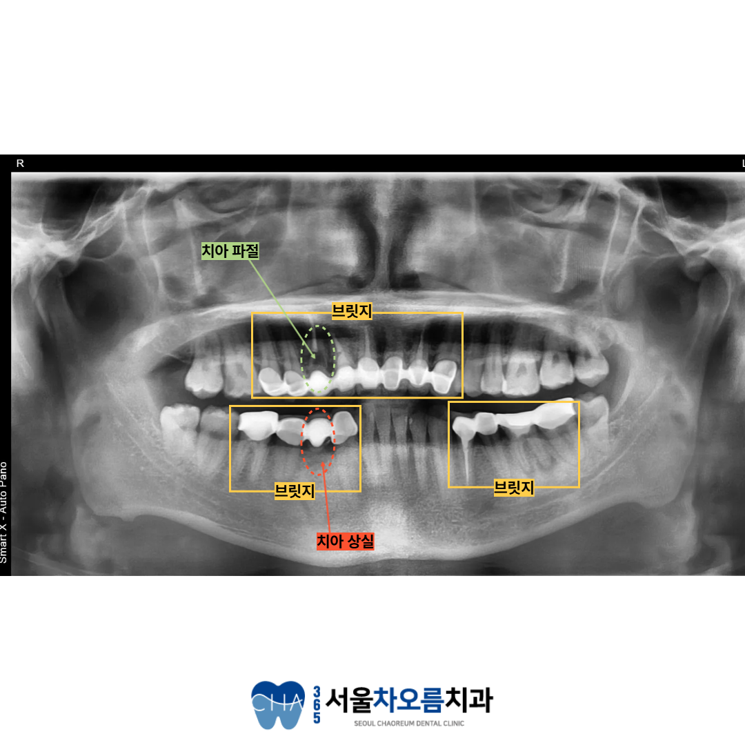 오대산역임플란트