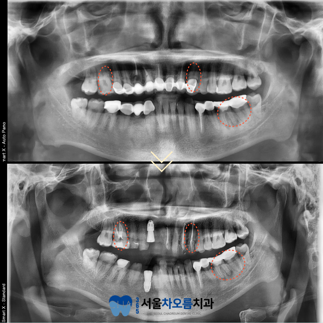 오대산역임플란트