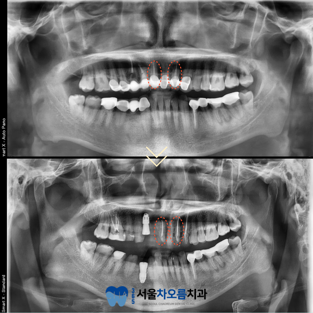 오대산역임플란트