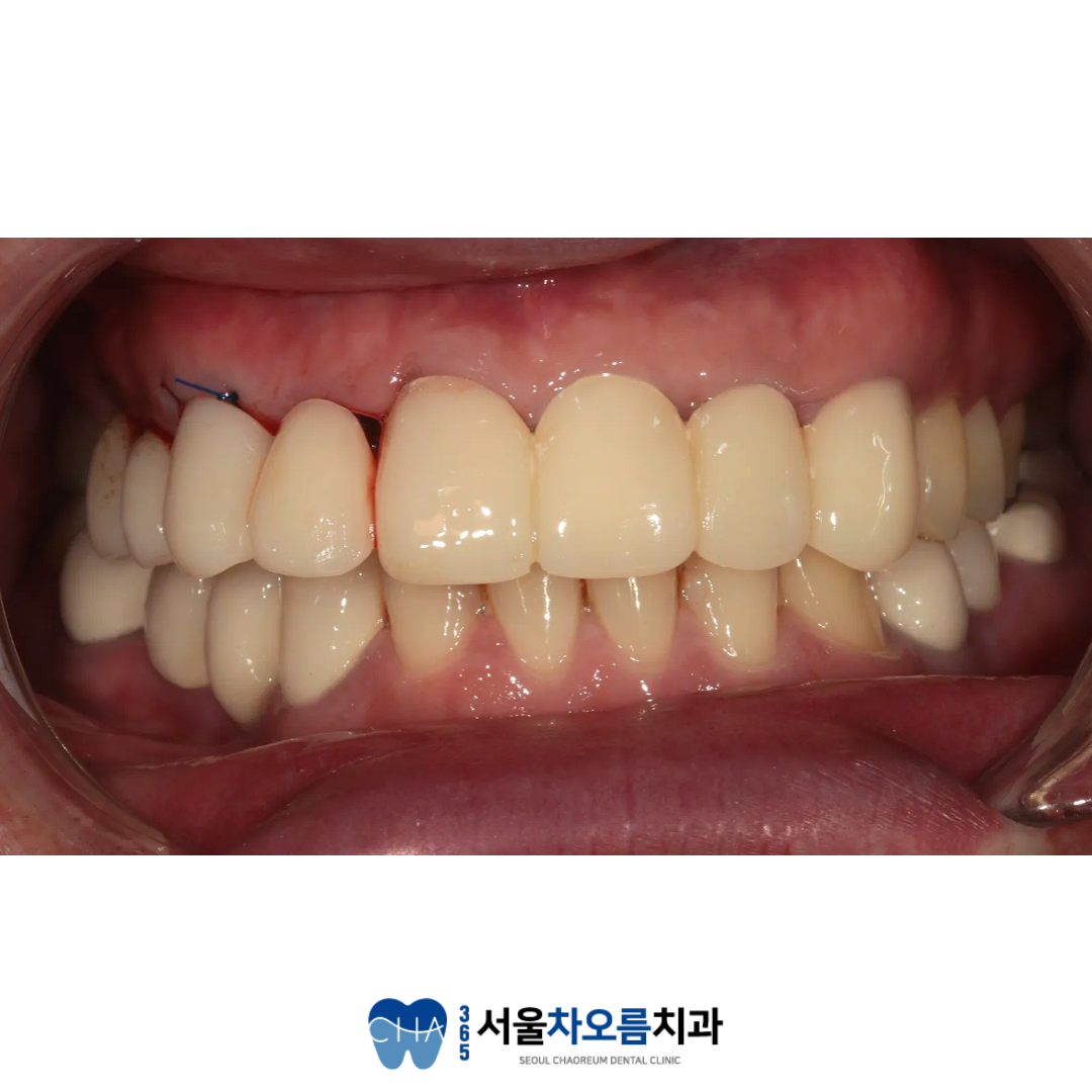 오대산역임플란트