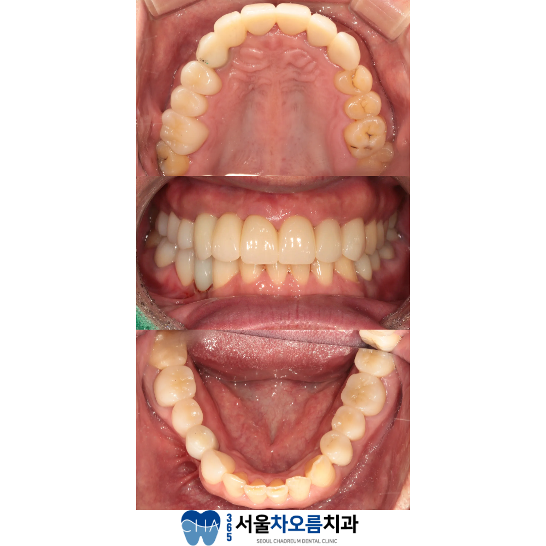 오대산역임플란트
