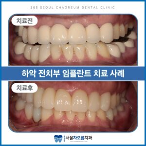 오대산역임플란트