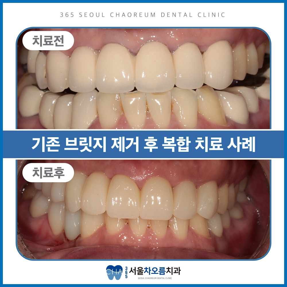 오산대역임플란트